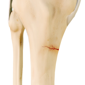 Knee Stress Fractures
