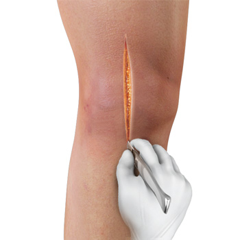 Knee Surgery