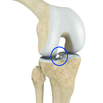 Loose Bodies in the Knee