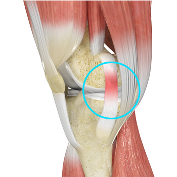 MCL Sprains