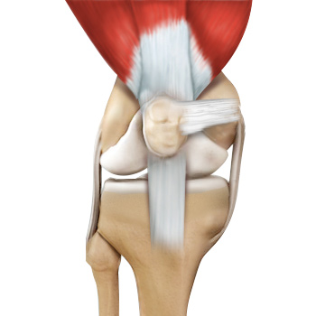 Medial Patellofemoral Ligament (MPFL) Tears