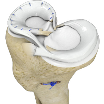 Meniscal Injuries