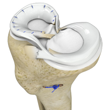 Meniscal Surgery