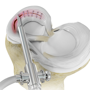 Meniscal Tears