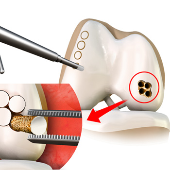 Mosaicplasty