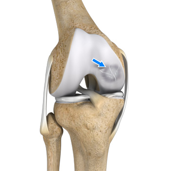Osteochondral Defect of the Knee