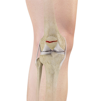 Fractures of the Patella