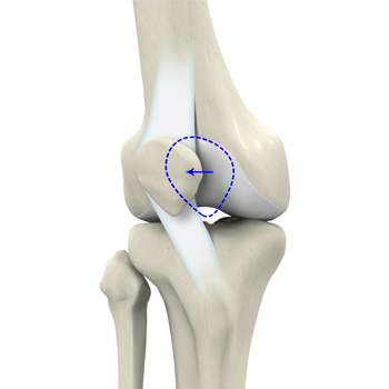 Patellar Dislocation/Patellofemoral Dislocation