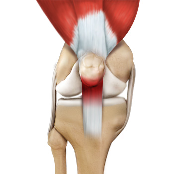 Patellar Tendinitis