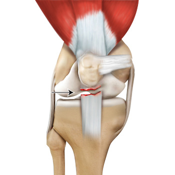 Patellar Tendon Rupture