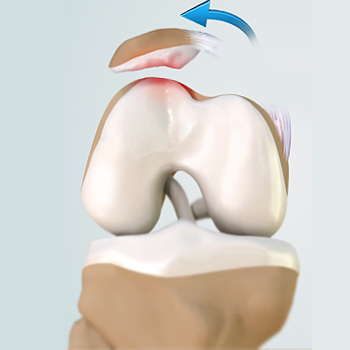 Patellofemoral Instability