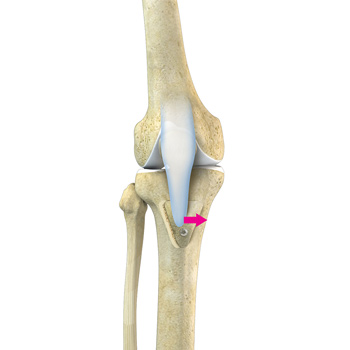 Patellofemoral Realignment