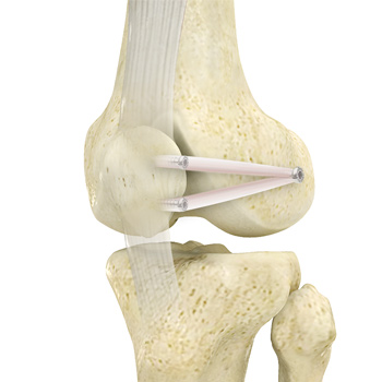 Patellofemoral Stabilization