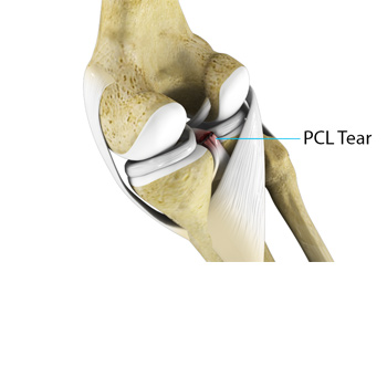 PCL Injuries