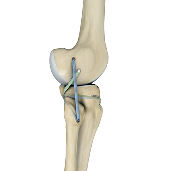 Posterolateral Corner Reconstruction