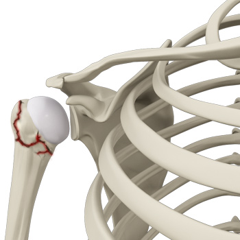 Proximal Humerus Fractures