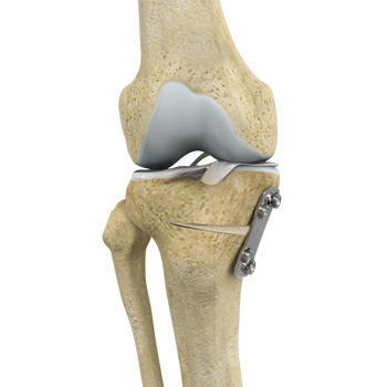 Proximal Tibial Osteotomy