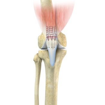 Quadriceps Tendon Repair