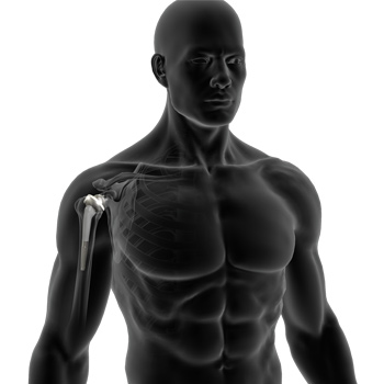 Reverse Shoulder Replacement
