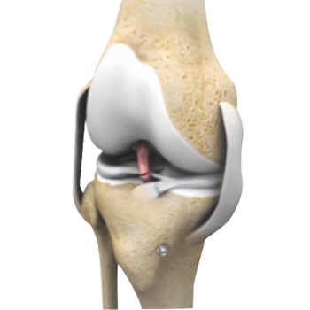 Revision Knee Ligament Reconstruction