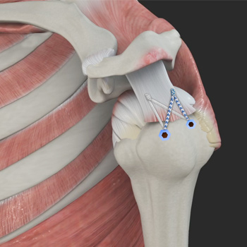 Rotator Cuff Repair