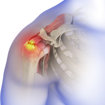 Rotator Cuff Tear