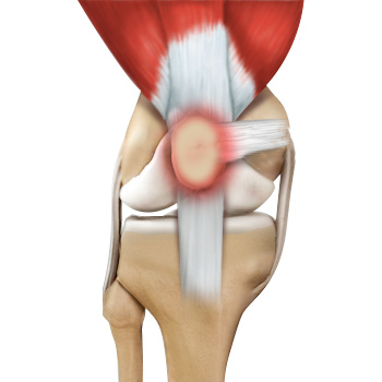 Runner’s Knee