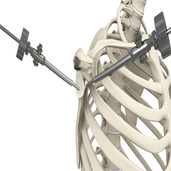 Shoulder Arthroscopy