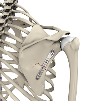 Shoulder Fracture