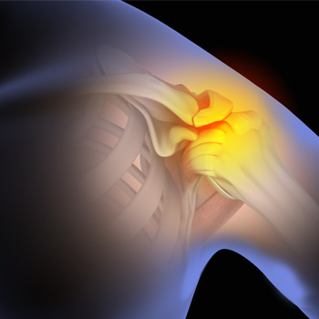 Shoulder Impingement