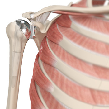 Shoulder Joint Replacement