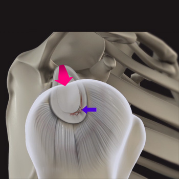 Shoulder Labral Tear with Instability