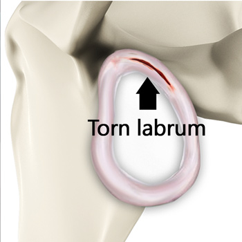 Shoulder Labral Tear