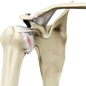 Shoulder Ligament Injuries