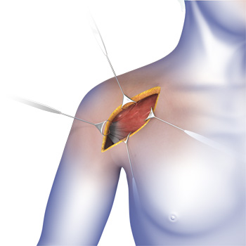Shoulder Surgery
