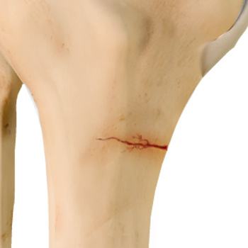 Stress Fracture of the Tibia