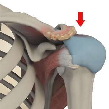 Subacromial Impingement Syndrome