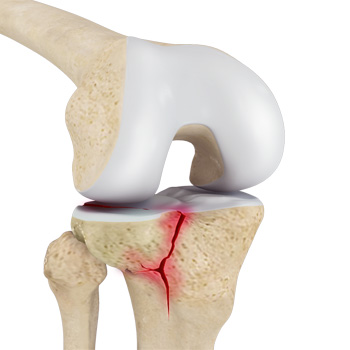 Tibial Plateau Fracture