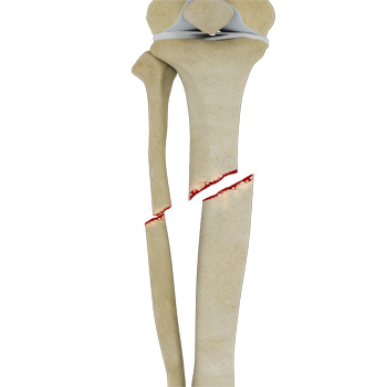 Tibial Shaft Fracture