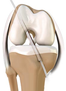 ACL Reconstruction - Educational Picture