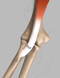Biceps Tendon Repair - Educational Picture