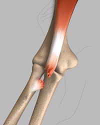 Bicep Tendon Rupture at Shoulder - Educational Picture