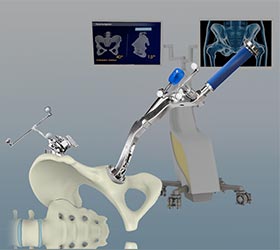 Computer Assisted Hip Replacement - Educational Picture