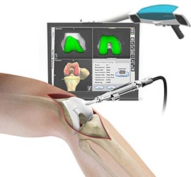 Computer Navigation for Total Knee Replacement - Educational Picture