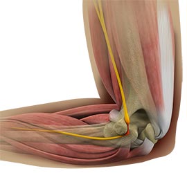Cubital Tunnel Release - Educational Picture