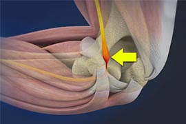 Cubital Tunnel Syndrome - Educational Picture