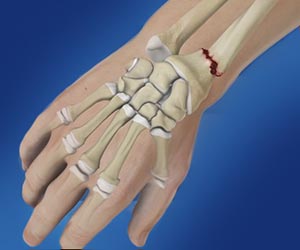 Distal Radius Fracture