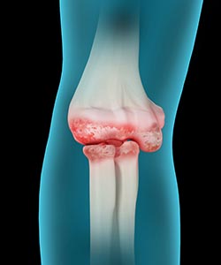 Elbow Arthritis - Educational Picture