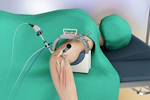 Elbow Arthroscopy - Educational Picture