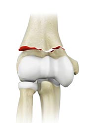 Elbow Fractures - Educational Picture